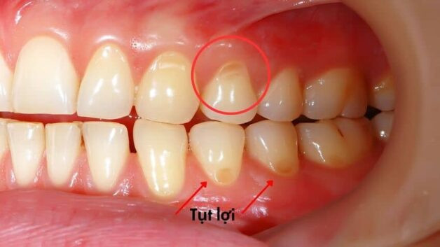 Vôi răng - Kẻ thù thầm lặng của nụ cười