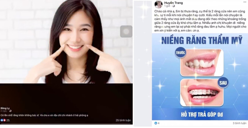 Niềng răng sợ đau? Nhổ răng sợ đau? Viêm nướu có nên làm răng sứ? Răng ố vàng nên tẩy trắng hay bọc sứ?